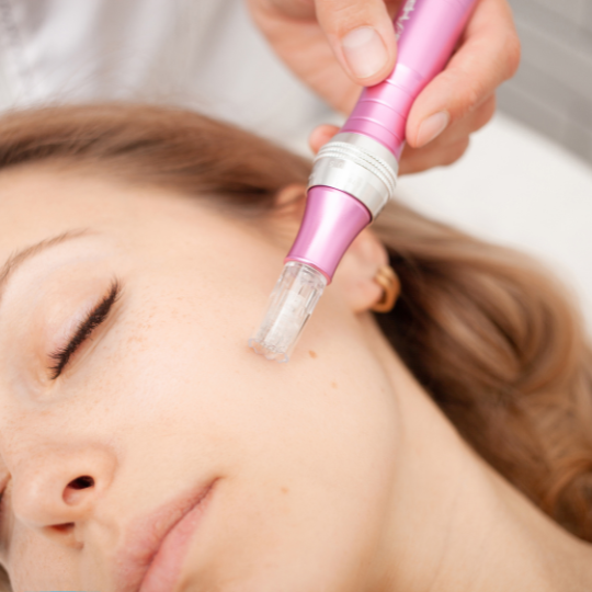 microneedling-chicago-il-2