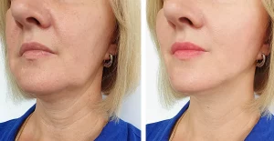 can-nano-needling-help-with-neck-wrinkles
