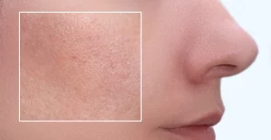 does-microneedling-shrink-pores