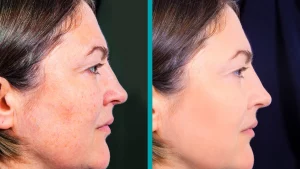 how-to-care-for-your-skin-after-nano-needling