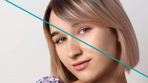 can-nano-needling-improve-acne-scars