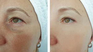 can-you-wear-makeup-after-microdermabrasion