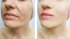 is-nano-needling-good-for-oily-skin