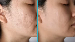 what-to-do-after-microneedling