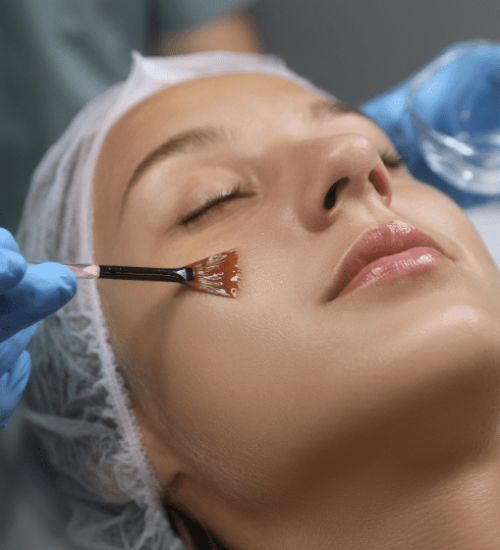 Chicago IL Chemical Peels